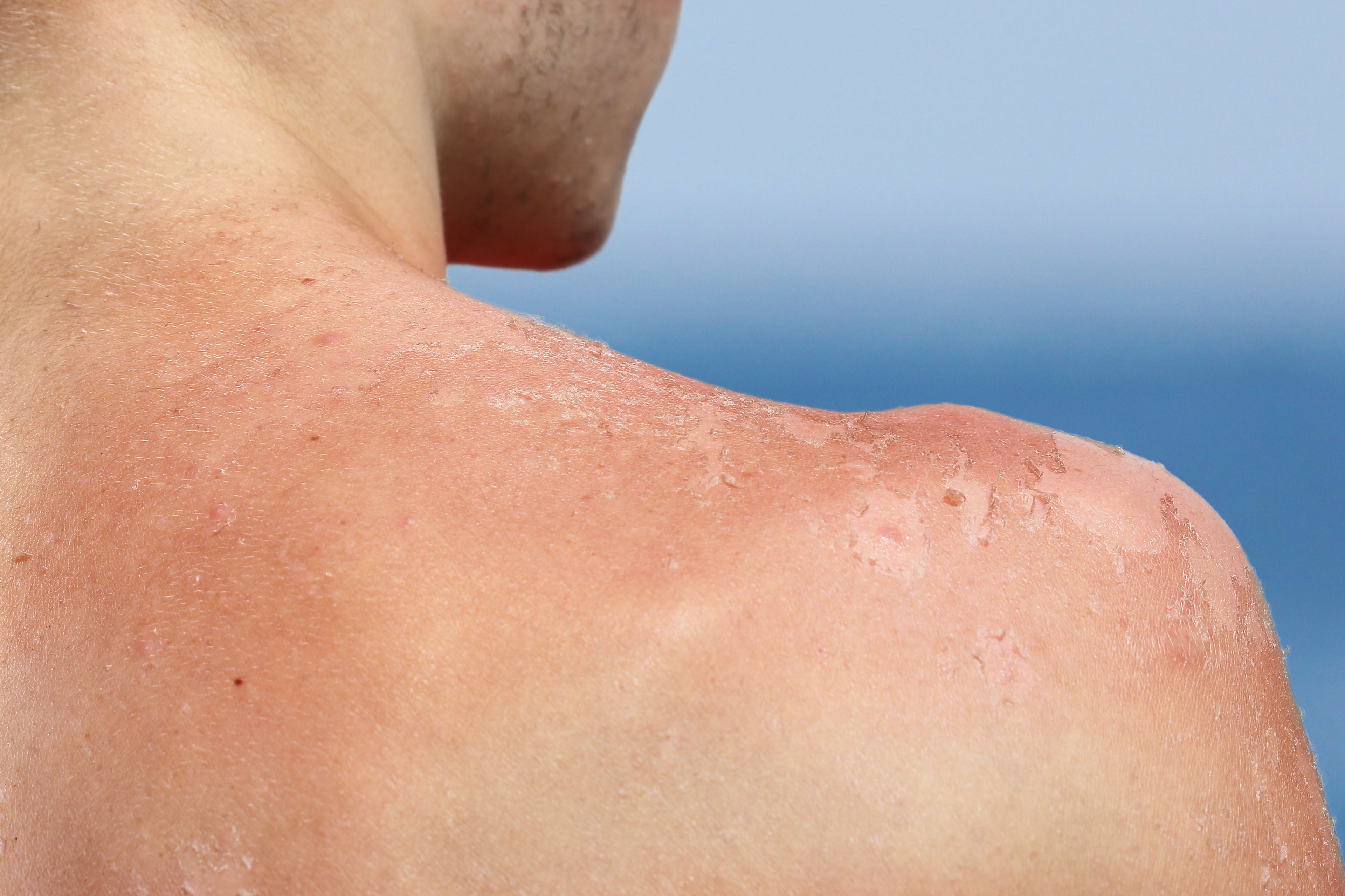The Surprising Benefits of Beef Tallow Balm for Sunburn Relief